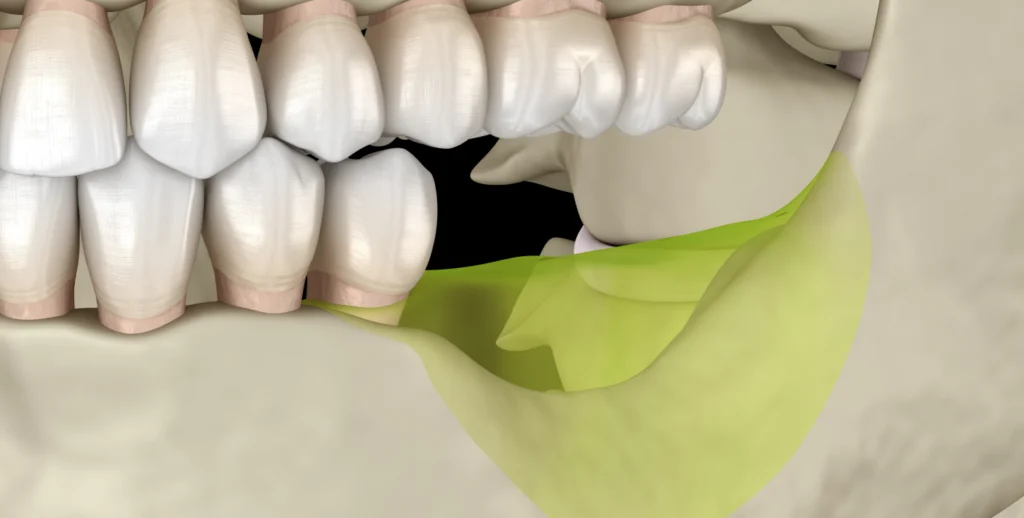 Apport osseux consolidant la zone à implanter — dentiste Le Beausset