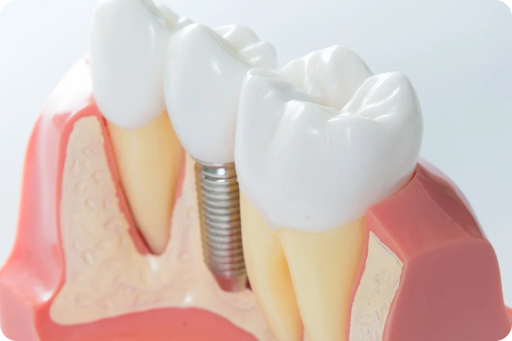 Pose d’implant dentaire par le Dr Oussalah — dentiste Le Beausset